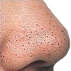 угревая сыпь